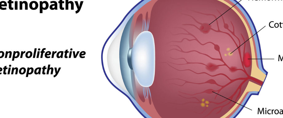 	
Stages of Diabetic Retinopathy